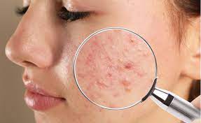 Acne - Os melhores tratamentos para ajudar no combate às espinhas - Lumina  Laser