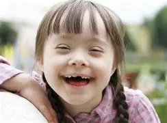 Resultado de imagem para sindrome de down