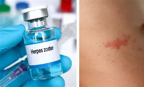 Resultado de imagem para   herpes-zóster 