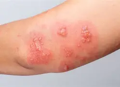 Resultado de imagem para   herpes-zóster 